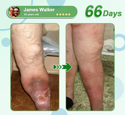[See results in 7 days]💎𝑳𝒆𝒓𝒄𝒆𝒂® 𝑵𝒂𝒏𝒐 𝑴𝒊𝒄𝒓𝒐𝒏𝒆𝒆𝒅𝒍𝒆 𝑷𝒂𝒕𝒄𝒉 𝒘𝒊𝒕𝒉 𝑺𝑴𝑮𝑻-𝑮𝑳𝑷-1 & 𝑴𝒂𝒕𝒓𝒊𝒙𝒚𝒍 3000（Painless, long-lasting）💚