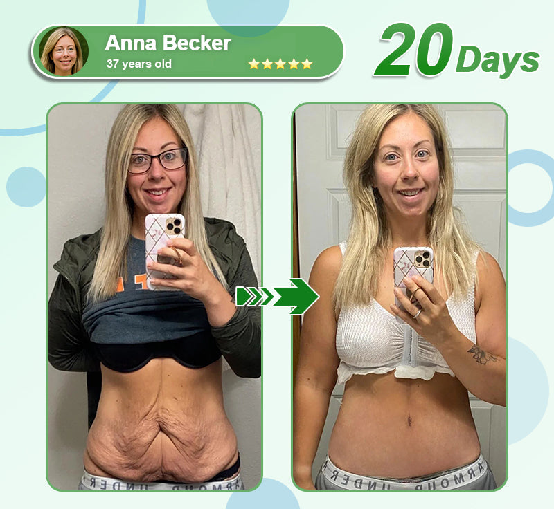 [See results in 7 days]💎𝑳𝒆𝒓𝒄𝒆𝒂® 𝑵𝒂𝒏𝒐 𝑴𝒊𝒄𝒓𝒐𝒏𝒆𝒆𝒅𝒍𝒆 𝑷𝒂𝒕𝒄𝒉 𝒘𝒊𝒕𝒉 𝑺𝑴𝑮𝑻-𝑮𝑳𝑷-1 & 𝑴𝒂𝒕𝒓𝒊𝒙𝒚𝒍 3000（Painless, long-lasting）💚