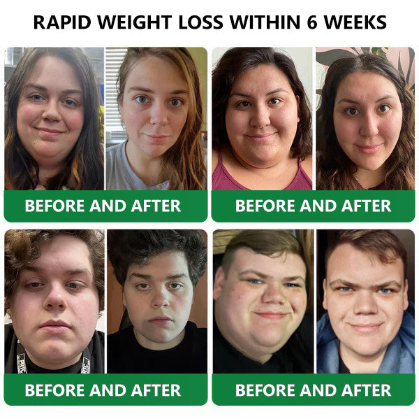 [See results in 7 days]💎𝑳𝒆𝒓𝒄𝒆𝒂® 𝑵𝒂𝒏𝒐 𝑴𝒊𝒄𝒓𝒐𝒏𝒆𝒆𝒅𝒍𝒆 𝑷𝒂𝒕𝒄𝒉 𝒘𝒊𝒕𝒉 𝑺𝑴𝑮𝑻-𝑮𝑳𝑷-1 & 𝑴𝒂𝒕𝒓𝒊𝒙𝒚𝒍 3000（Painless, long-lasting）💚